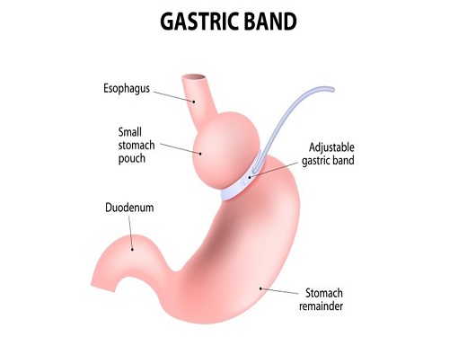 Adjustable Gastric Banding (AGB)