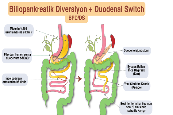 Biliopancreatic Diversion with Duodenal Switch (BPD/DS)