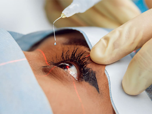Retinal Photocoagulation : Treatment – Recovery – Cost