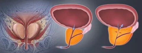 Benign prostatic hyperplasia Treatment