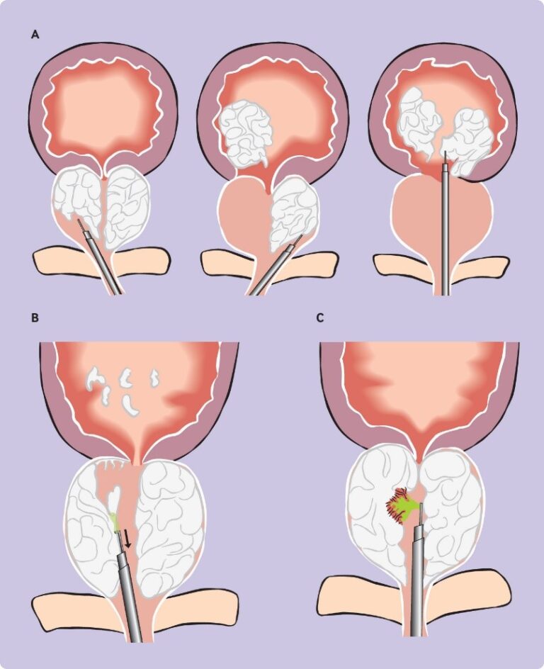benign prostatic hyperplasia surgery types