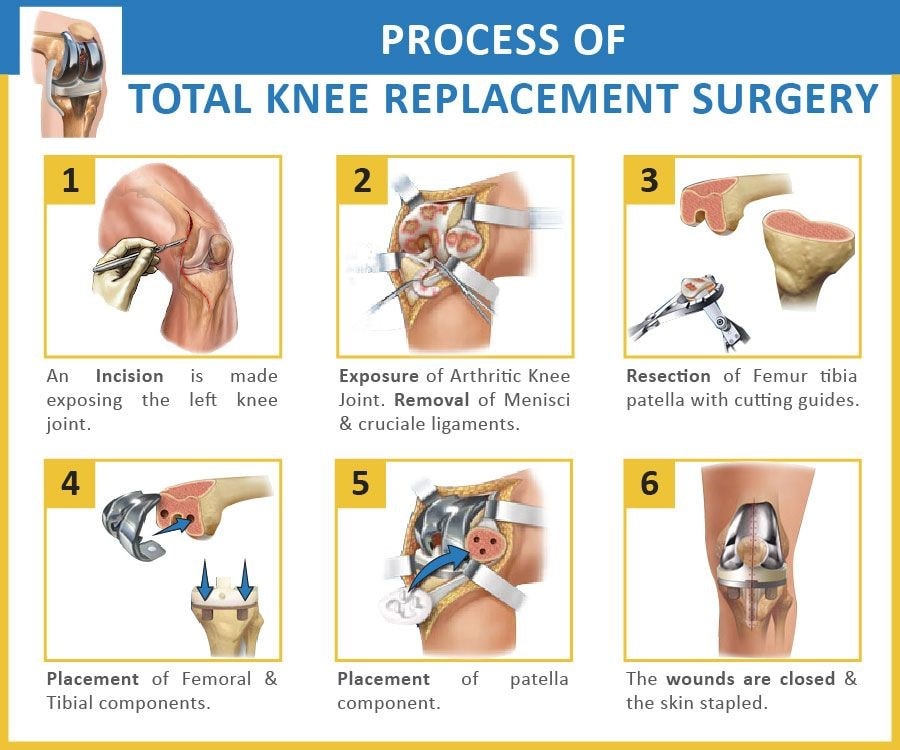 Knee Replacement Surgery Procedure